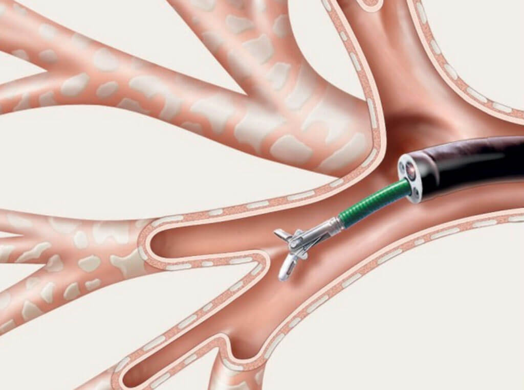 Researchers develop Covid-19-friendly bronchoscopy device